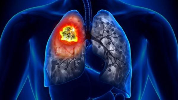 نشانه های ابتلا به سرطان ریه را بشناسید