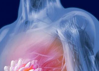 راهی برای پیش بینی ابتلای زنان به سرطان سینه