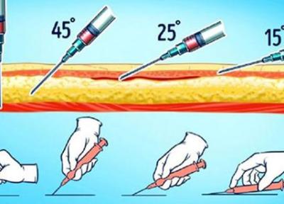آموزش تصویری تزریق عضلانی به خود و دیگران